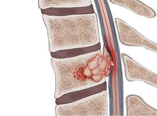 Spine Oncology Treatment in Sector 77